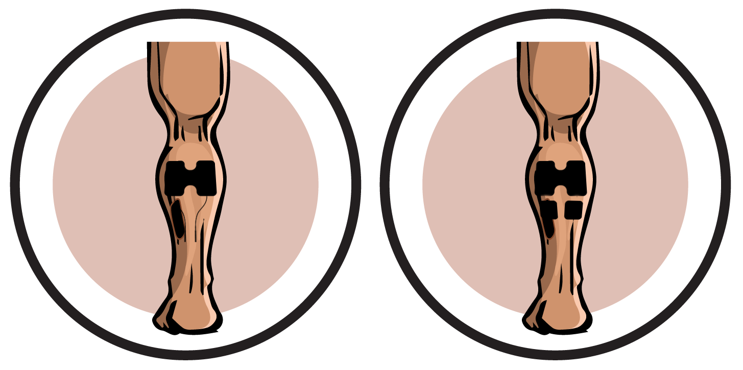 Calves Electrode Pad Placements