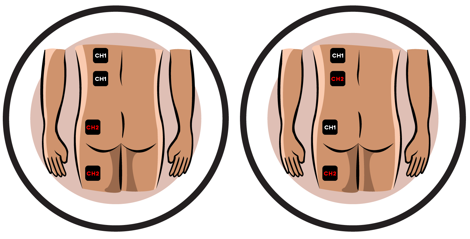 Hip Neuralgia Electrode Pad Placement