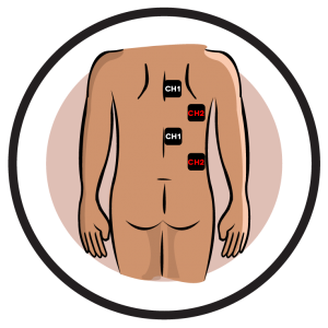 Mastectomy-Right Side Electrode Pad Placement