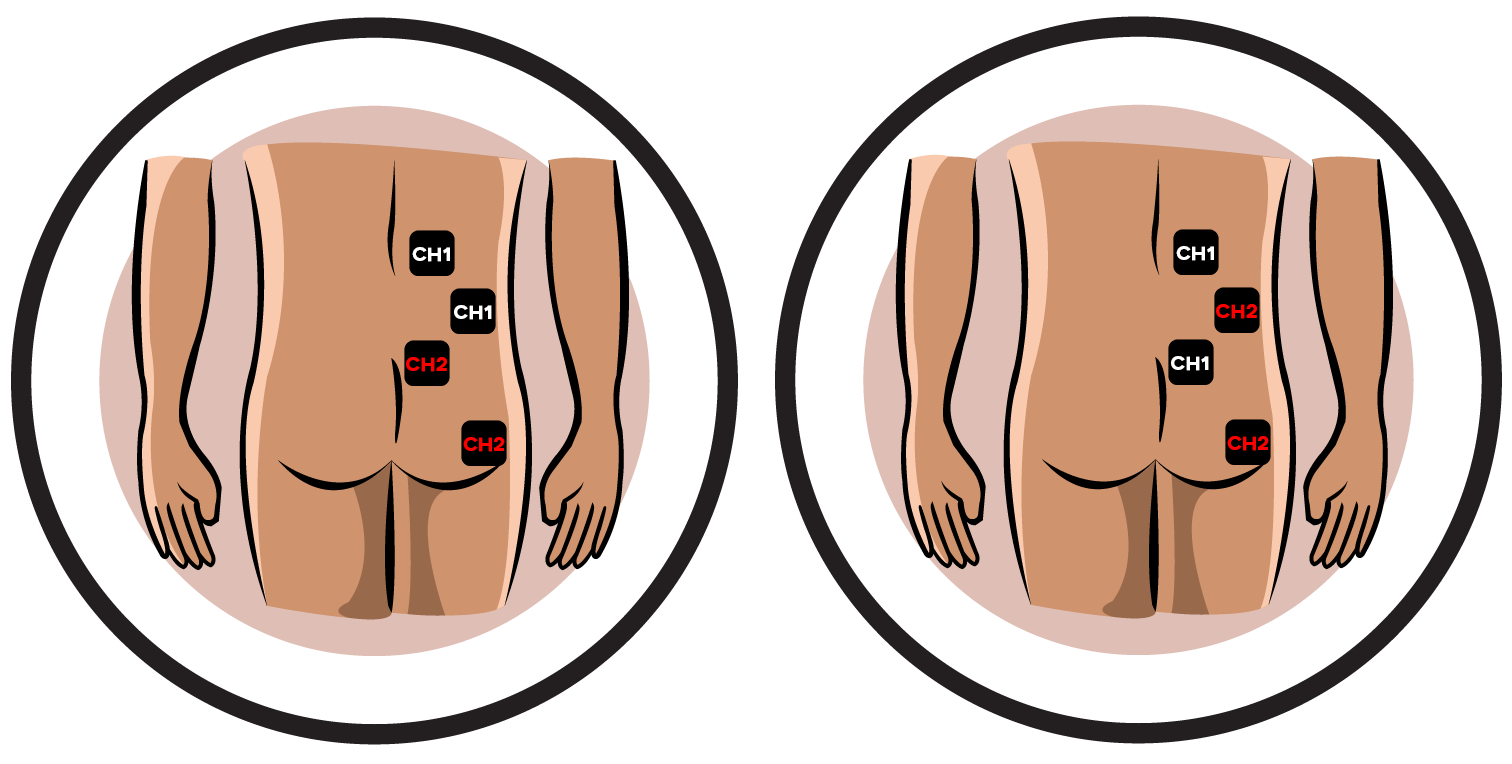 Phantom Limb Electrode Pad Placement