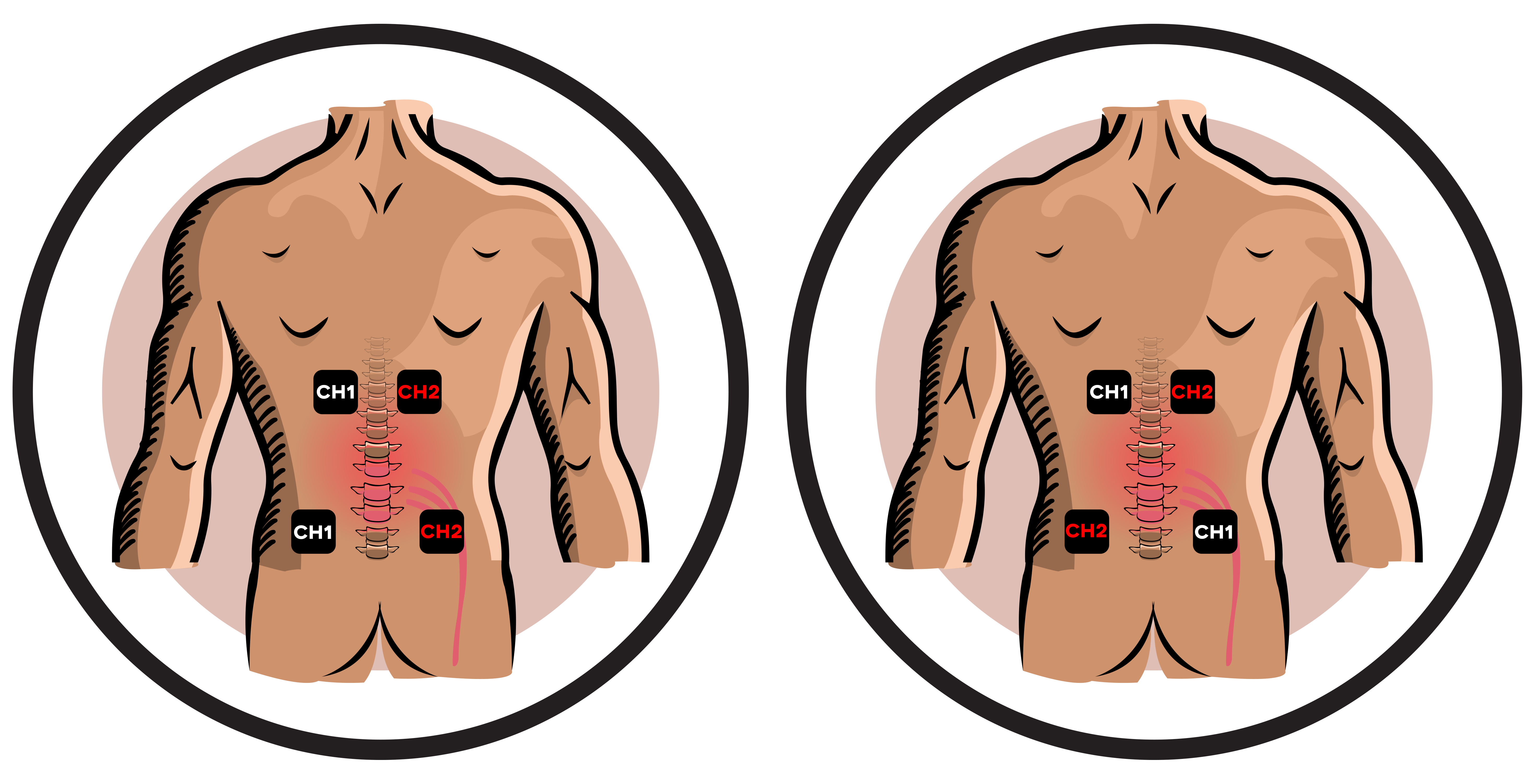 Sciatica Electrode Pad Placement