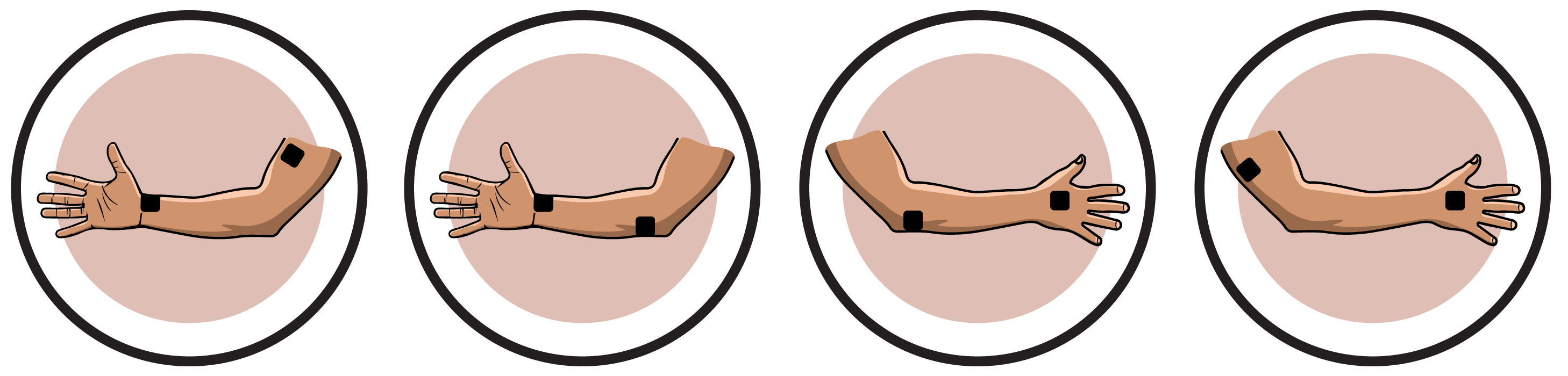 Ulnar Nerve Lesion Electrode Pad Placement