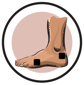 Post Podiatric Surgery Involving Lateral Toes Electrode Pad Placement Lower Foot