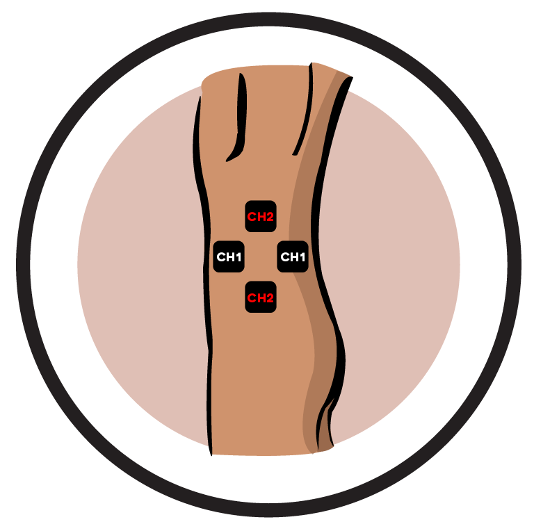 Hip Electrode Pad Placement