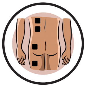 Hip neuralgia Electrode Pad Placement