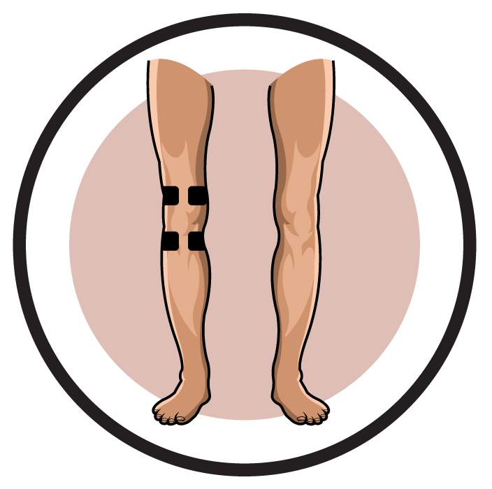 Knee Electrode Pad Placement