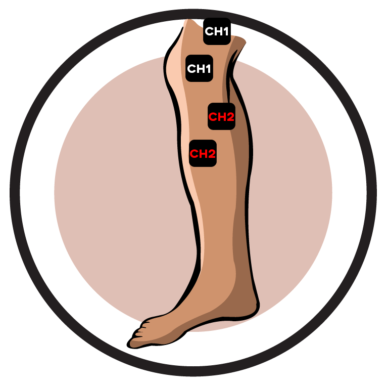 Recurrent Patellar Subluxation Electrode Pad Placement