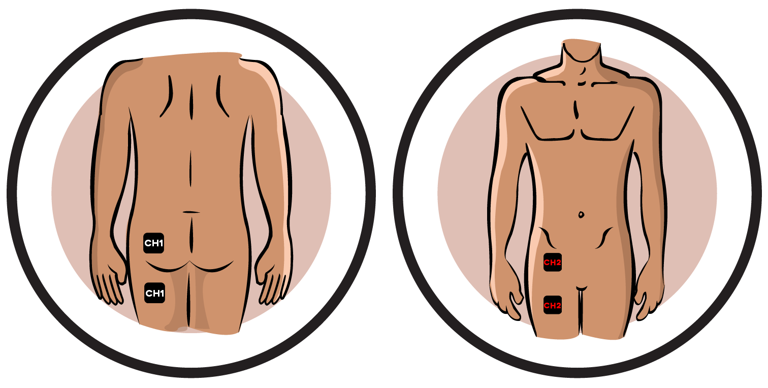 Low Extremity Pain-Reflex Sympathetic Dystrophy Electrode Pad Placement