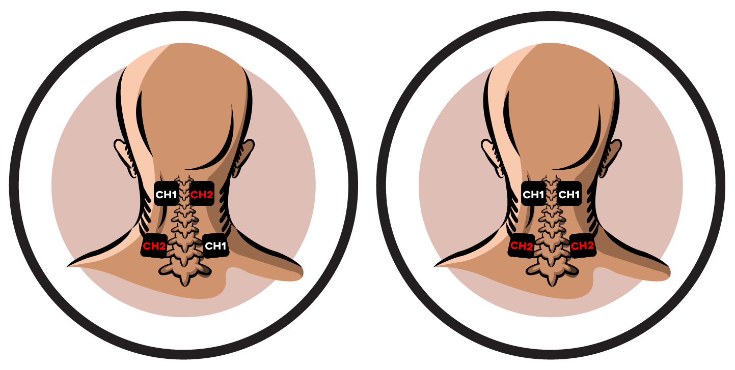 Cervical Osteoarthritis Electrode Pad Placement