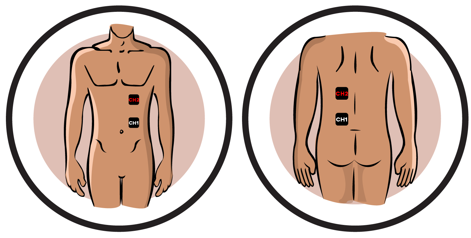 Herpes Zoster Neuralgia Electrode Pad Placement