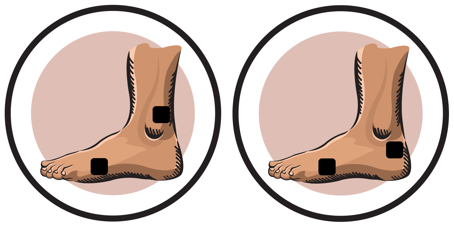 Post-Podiatric Surgery Involving Lateral Toes Electrode Pad Placement