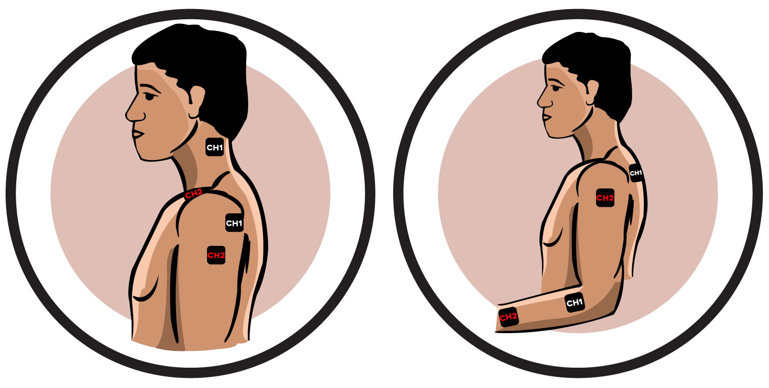 Upper Body Reflex Sympathetic Dystrophy Electrode Pad Placement